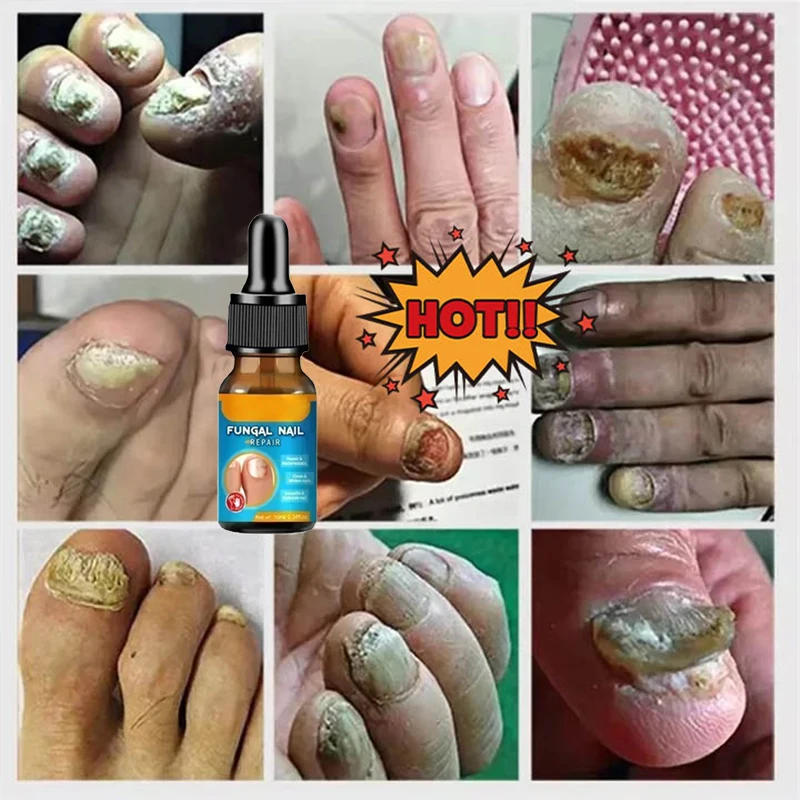 Zehennagel-Nagelpilz-Behandlung, Reparatur, Fingernagel-Gerät, Zehennagel-Behandlung für Fußnagelpilz, ätherisches Öl, Onychomykose-Pflege