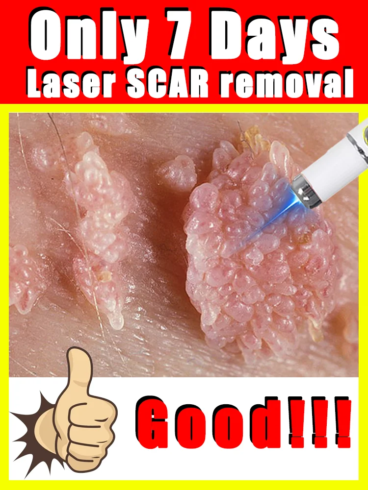 Caneta de luz azul resolve verrugas, ferramentas de cuidados com a verrugas, pés, ombros, pescoço, cabeça, mãos, frete grátis