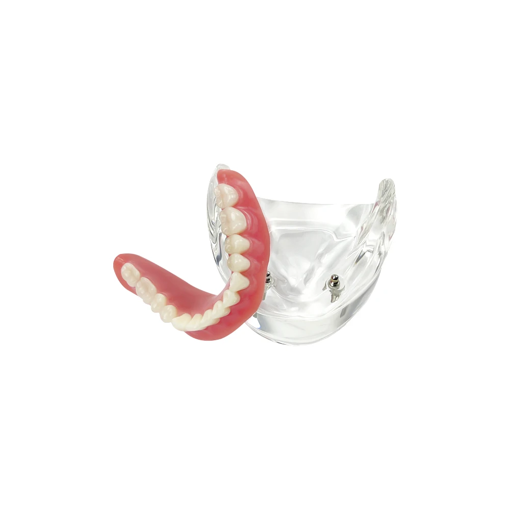 Lower Dental Teeth Model Overdenture Superior with 2 Implant Restoration Interior Mandibular Teach Model for Teaching Study