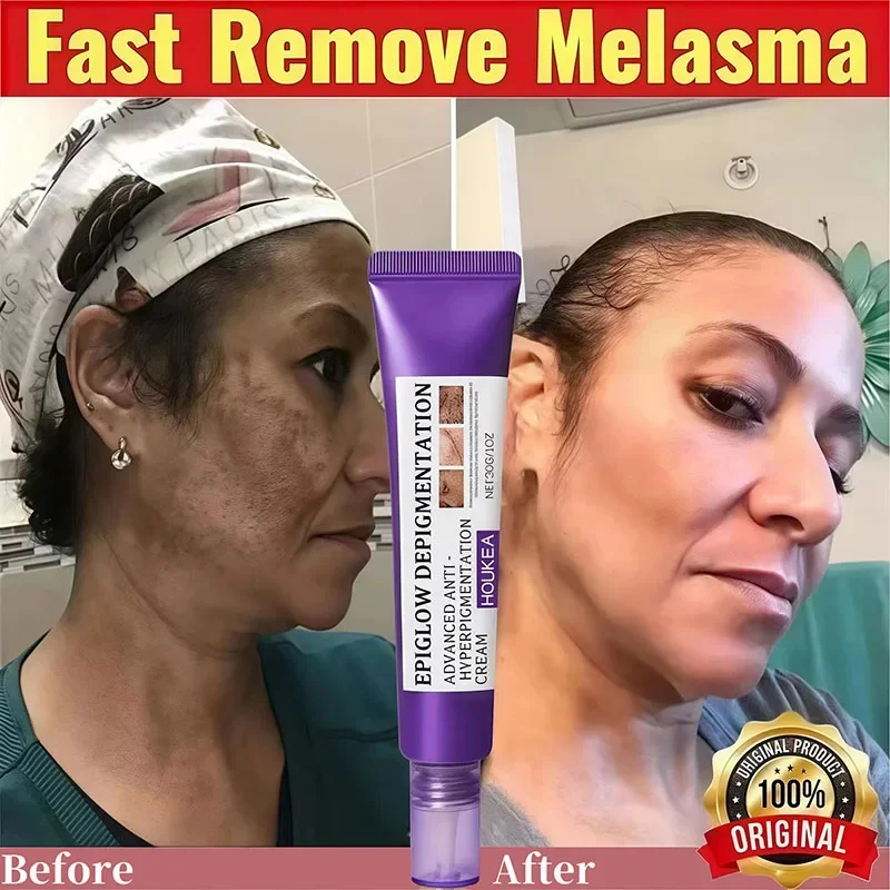 Retinol Whitening Sommersprossencreme Melasma Dunkle Flecken Pigmentierung Entfernung Verblassen Fleck Melanin Schnelle Reparatur Aufhellen Koreanische Hautpflege