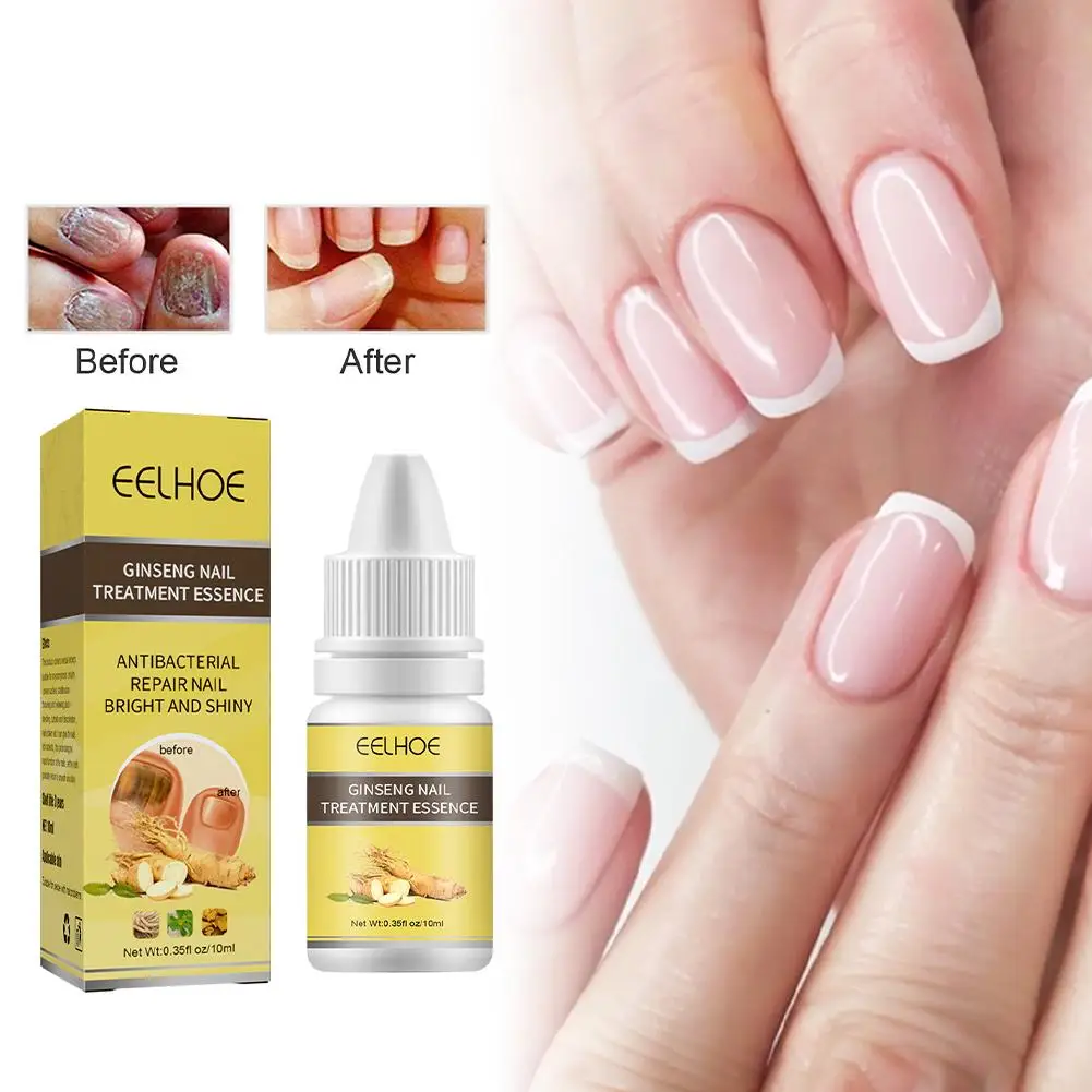 10Ml Nagel Schimmel Verwijdering Crème Onychomycosis Schimmel Nagel Schimmel Nagelinfectie Zorg Zalf Anti Behandeling Voeten Teen Paronie Q4i9