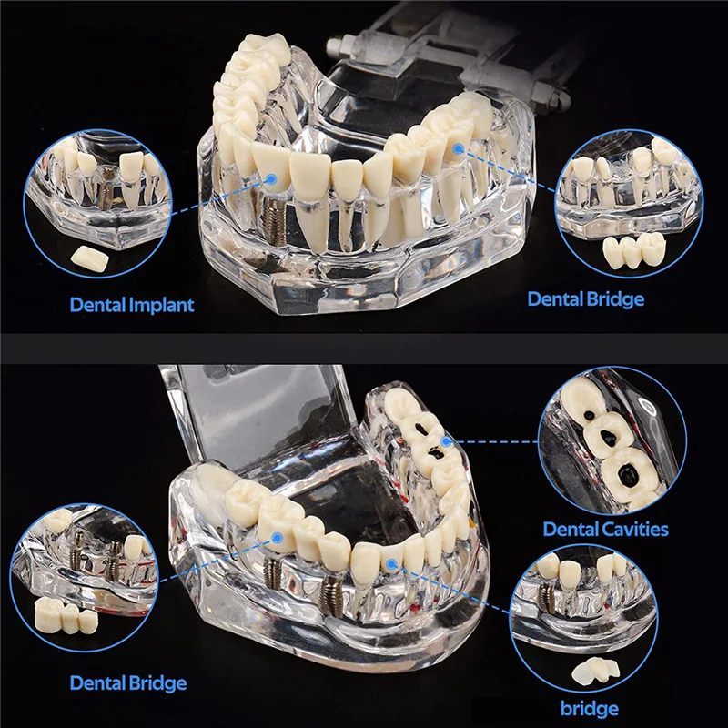 

Practical-1 PCS Transparent Disease Teeth Model With Implant Bridge, Transparent Plastic For Patient And Student E