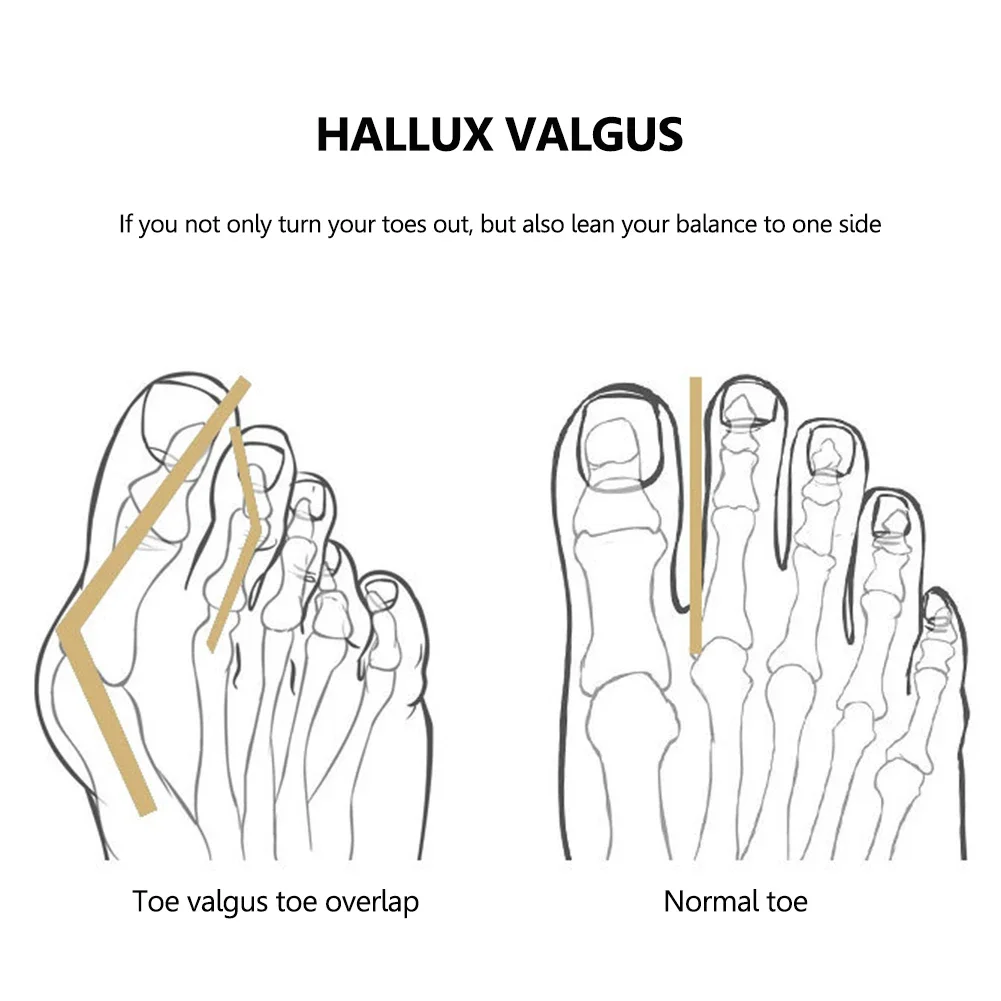 Bunion Corrector Adjustable Orthopedic Bunion Toe Straightener Hallux Valgus Corrector for Big Toe Bunion Relief
