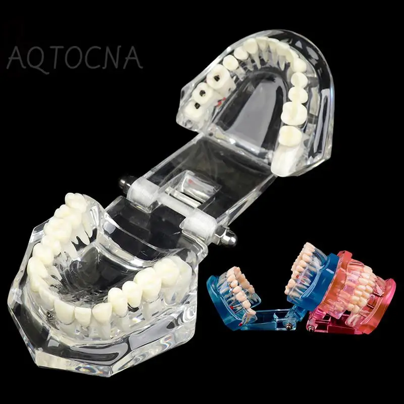 

Teeth Repair Model Disease Teeth Model For Dentist Student Practice Training Studying Oral Medical Dentistry Tools