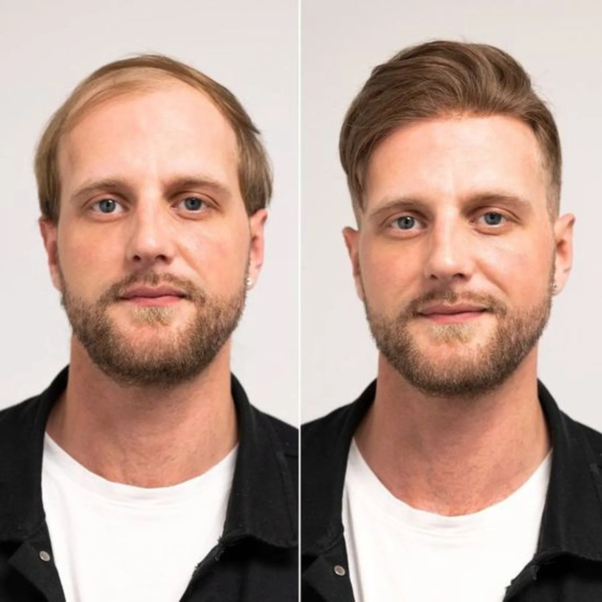 نظام استبدال الشعر المستعار 100% نظام شعر أوروبي من الدانتيل البشري الحقيقي بدانتيل أمامي وأعلى مع PU