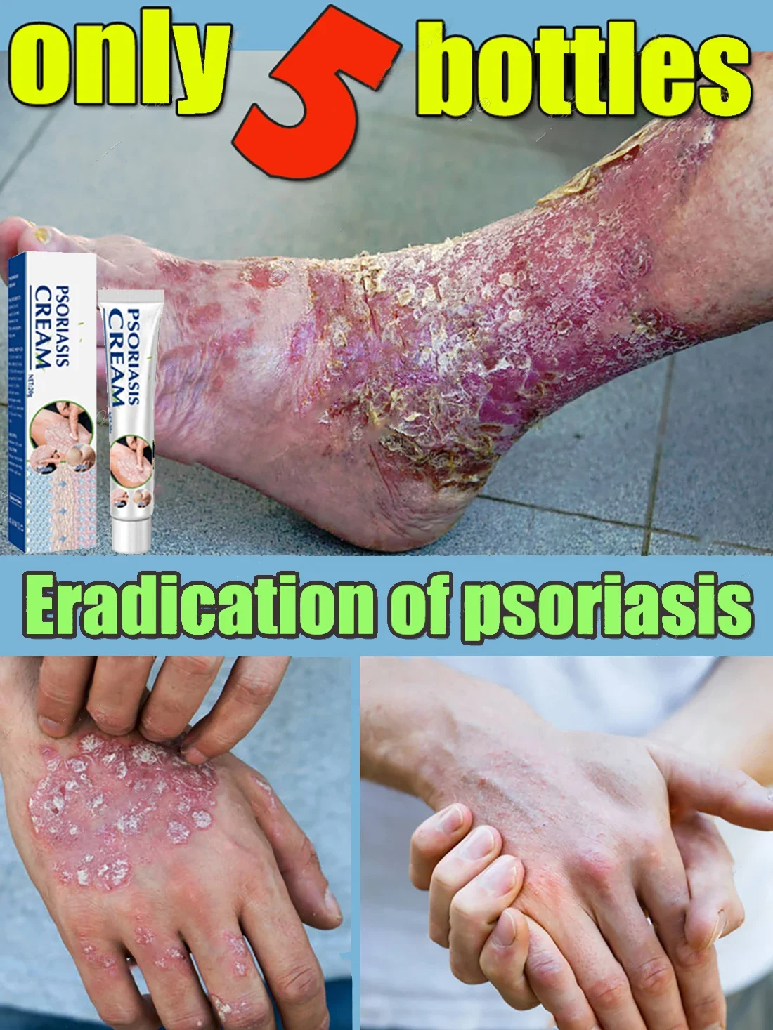 Рисунок 4 - Крем от псориаза