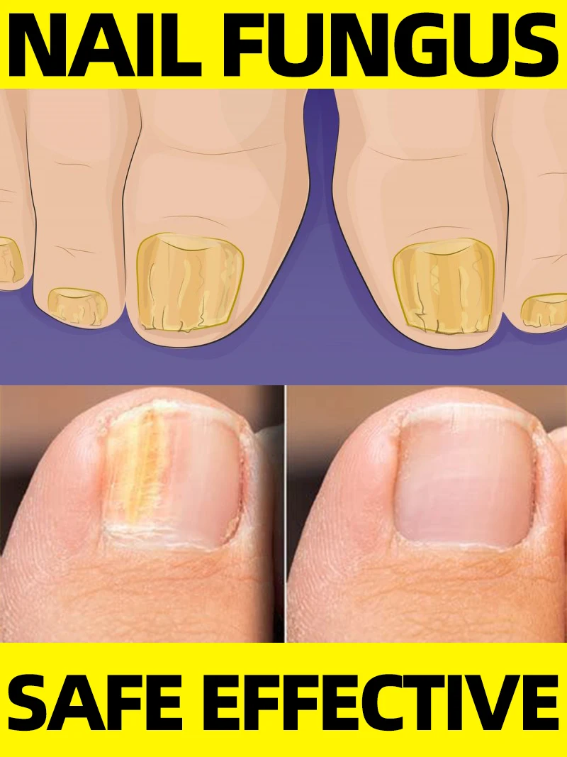 

Repair yellowed and thickened nails