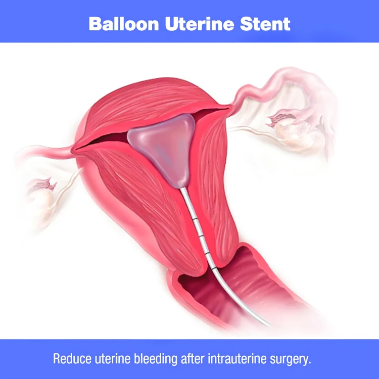 Instruments Silicone Disposable Balloon Uterine Stent to Prevent Adhesion Reformation After