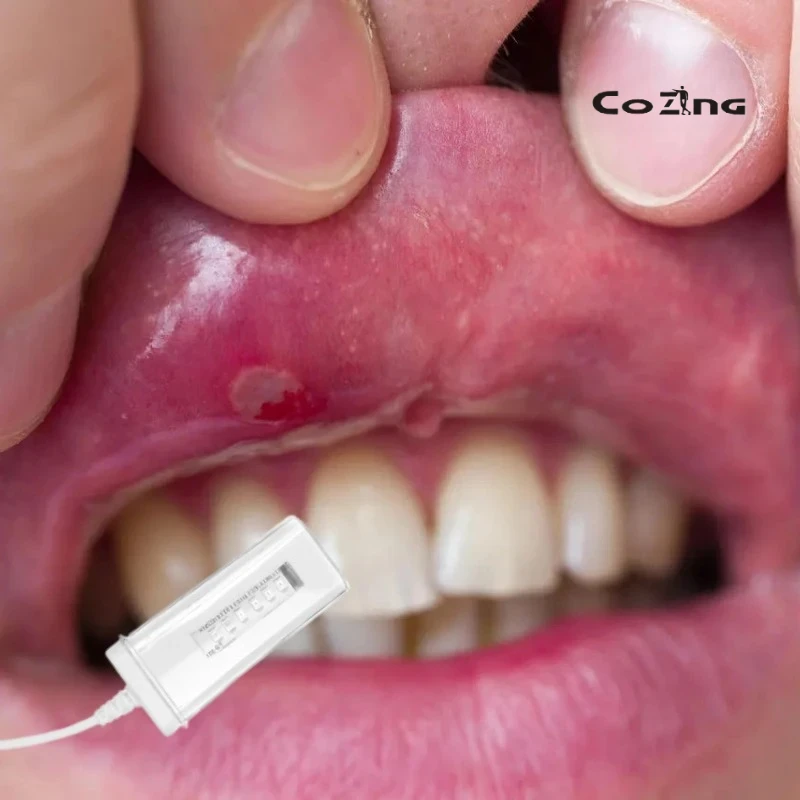 

COZING USBO Oral Laser Therapy Device for Snore Relief and Throat Inflammation Treatment USB Portable Red Light