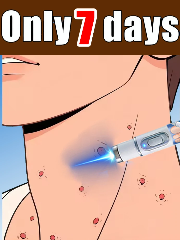 

Синий световой карандаш, 2-в-1, средство для ухода за телом, лицом и шеей, забудьте о проблемах с бородавками