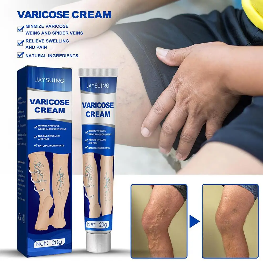ointment for varicose veins Effective varicose vein relief cream to relieve Leg vasculitis phlebitis spider pain treatment K4Z1