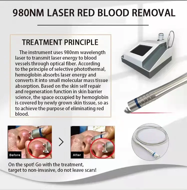 Manufacturer Sales Spider Vein Removal  980nm Spider Veins Vascular Removal Machine