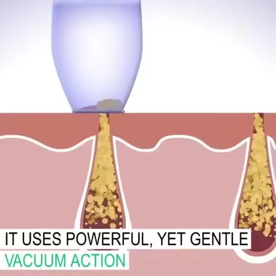 الجملة المهنية الكهربائية فراغ الرؤوس السوداء حب الشباب أداة إزالة الرؤوس السوداء المسام فراغ