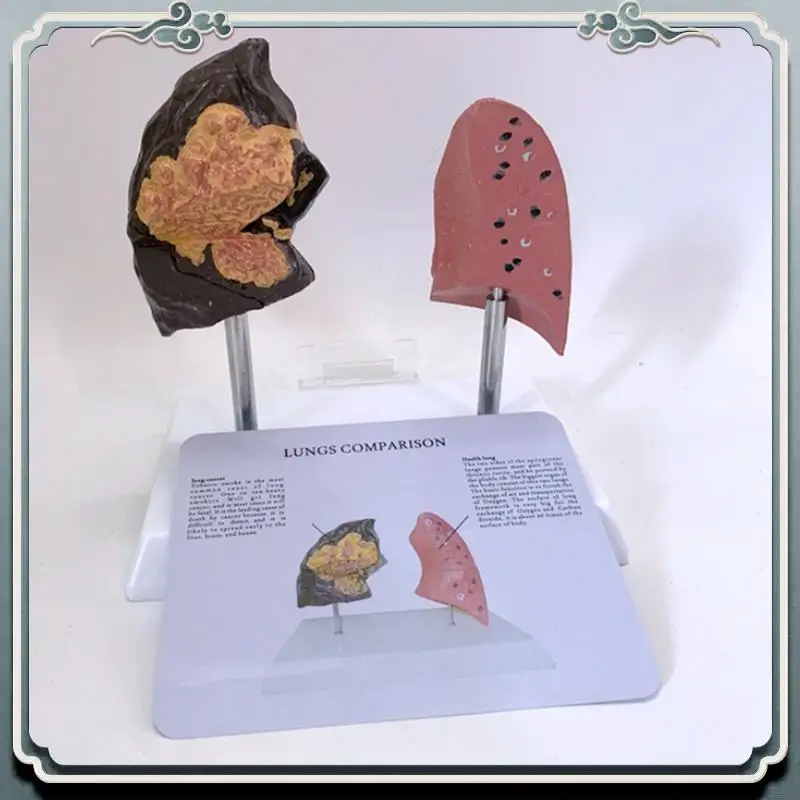 

Premium Healthy Lung Model Lung Anatomy Model With Pathological Respiratory System Disease Lungs