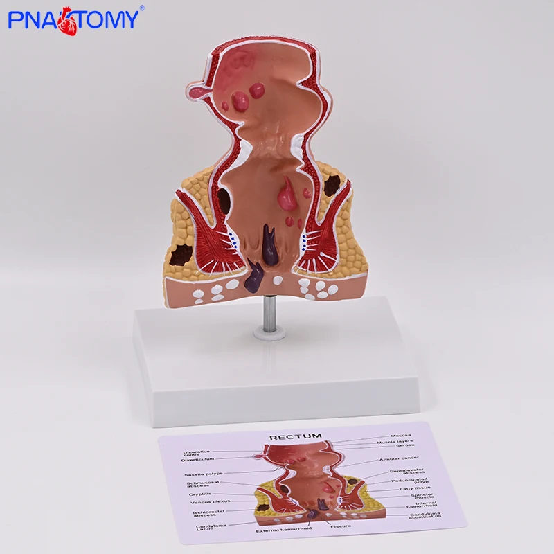 Teaching Model of Rectal Pathology Model Intestinal Specimen Human Anatomy Model Hemorrhoids Anal Lesions Medical Gift