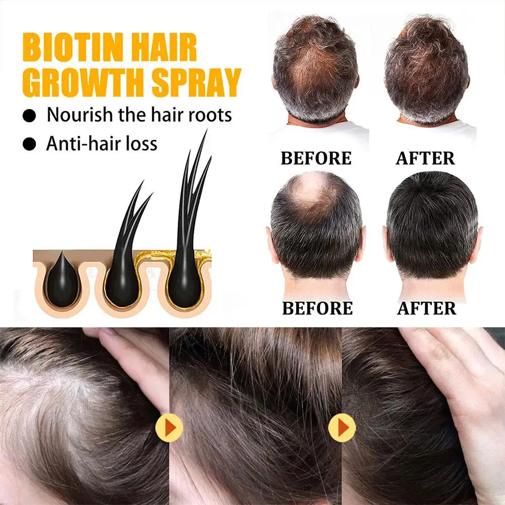 1-5pcs produk semprot cepat Serum Rambut rontok mencegah perawatan kebotakan kulit kepala kering rusak minyak esensial kecantikan rambut