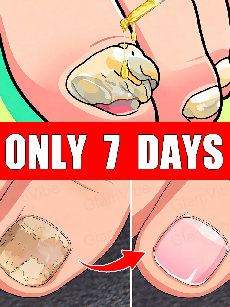 Nails that have changed color, become brittle,or splitᴰⁱˢⁱⁿᶠᵉᶜᵗ ᵃⁿᵈ ᵖʳᵒᵗᵉᶜᵗ ʸᵒᵘʳˢᵉˡᶠ