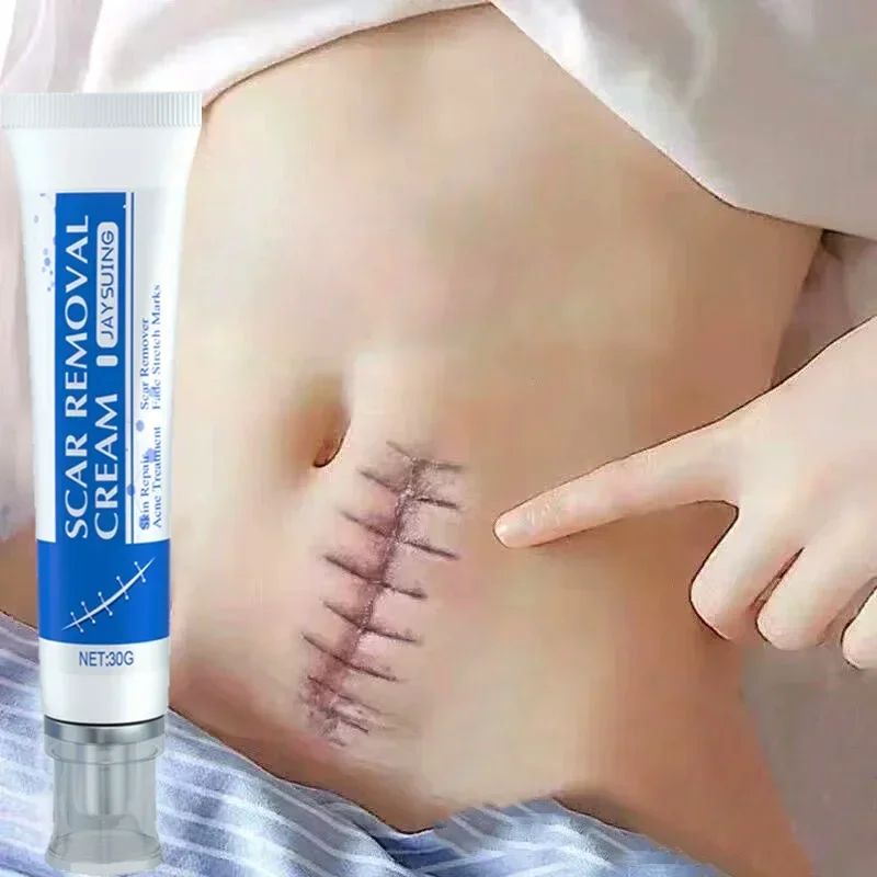 

Keloid Scar Fast Removal Cream Treatment Stretch Marks Burn Surgical Hyperplasia Scars Acne Spots Repair Whiten Smooth Skin Care