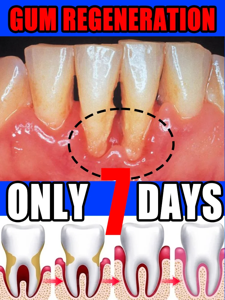 

New Year's Special Offer! Periodontitis repair, say goodbye to bleeding gums, and get healthy gums back – buy 3 get 2 free!