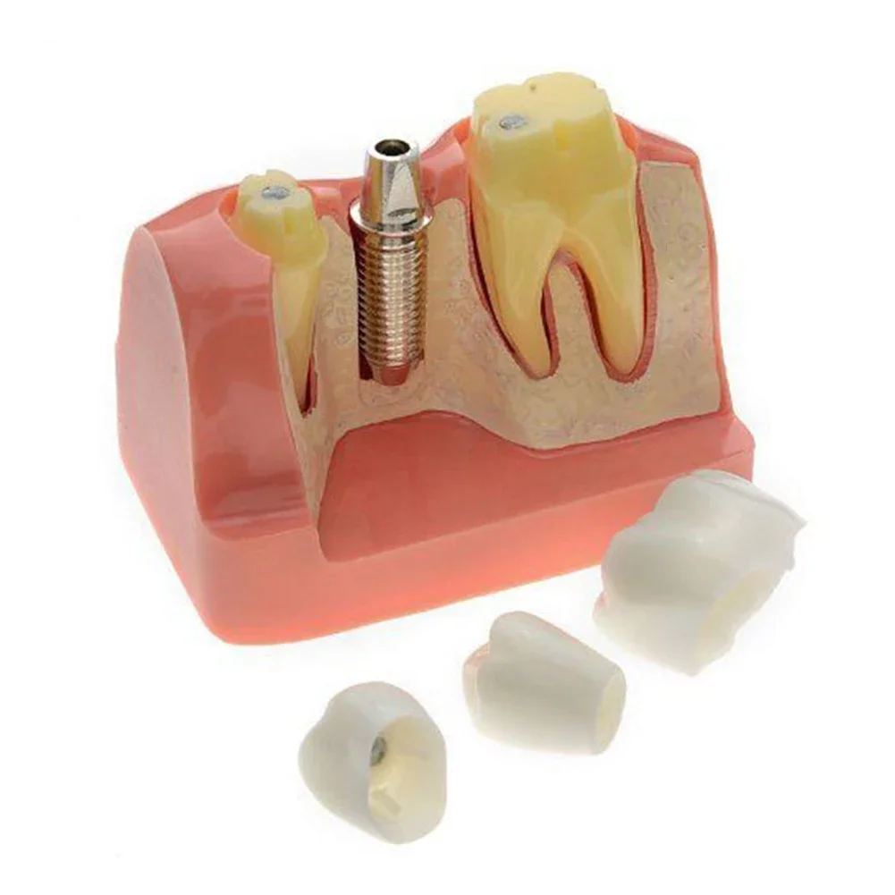 

4-кратная стоматологическая обучающая модель, анализ имплантатов, коронный мост, демонстрационная форма для протезов, набор съемных смоляных вставных зубов для стоматолога