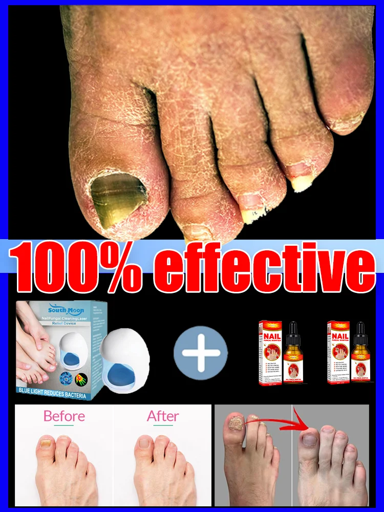 Laser treatment devices for treating onychomycosis, fungal infections, and various foot problems