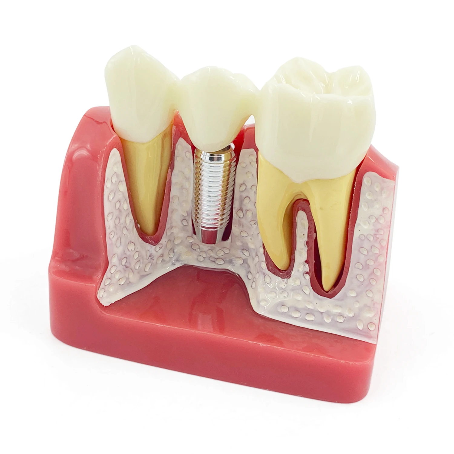 WellCK Dental Teaching Implant Analysis Crown Bridge Removable Model Dental Demonstration Teeth Model