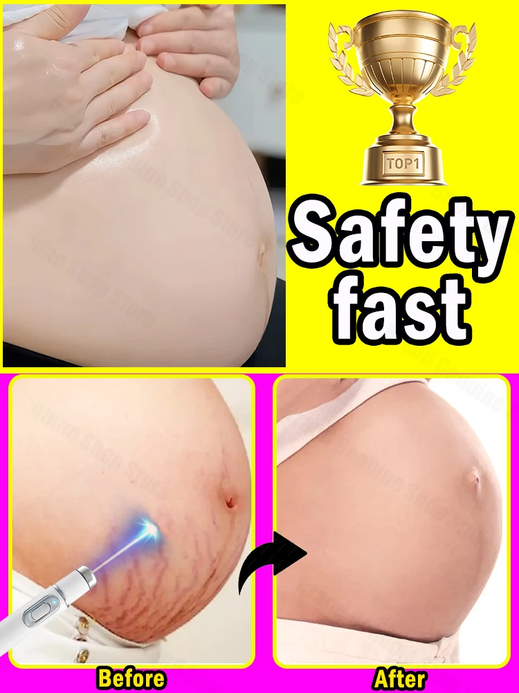 Cream for marks after pregnancy, postpartum skin care