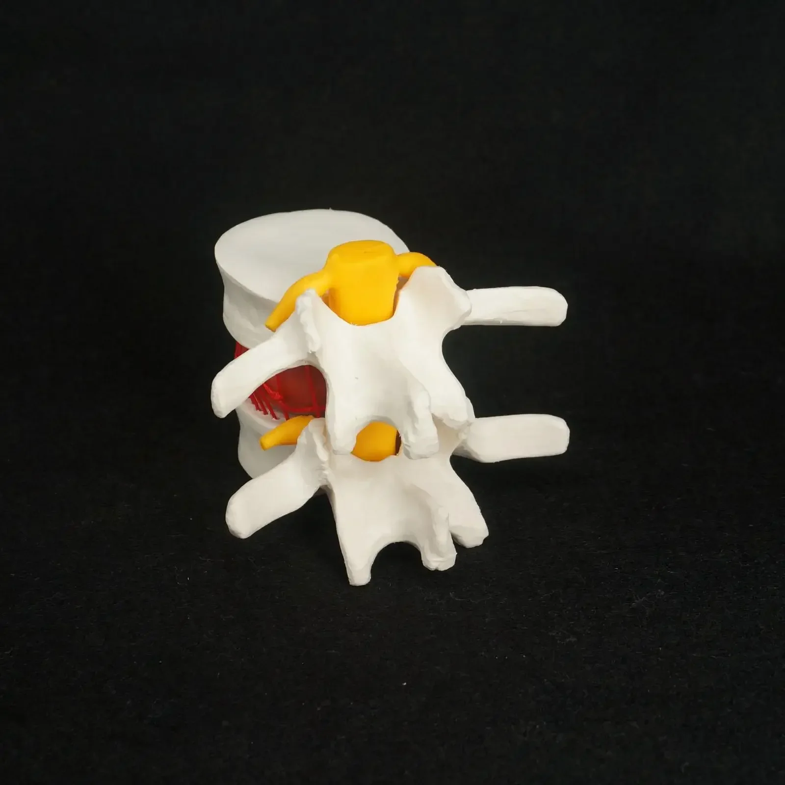 Modelo de prolapso de disco de vértebras lumbares hernia anatómica de PVC anatomía médica humana