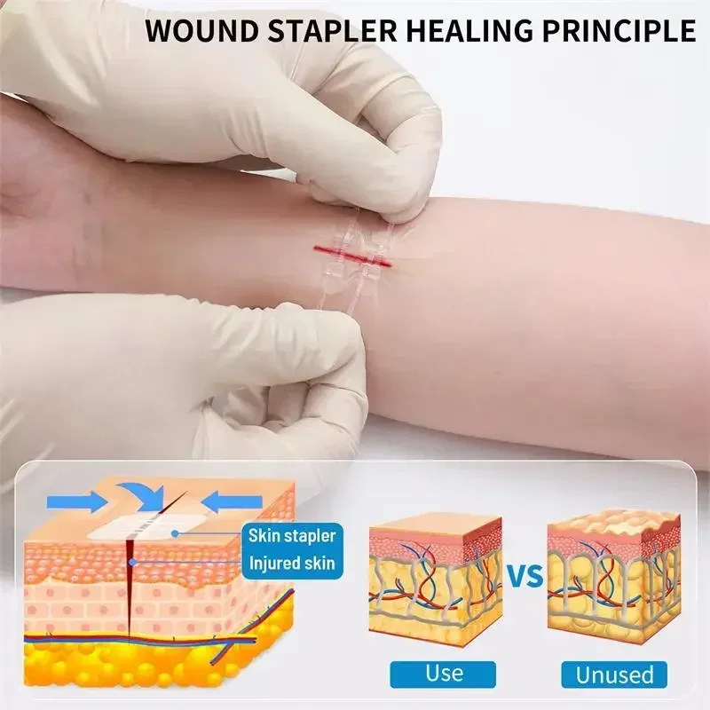 Zipper Band-Aid Wound Closure Device Wound Tie Emergency  Repair Wounds Without Stitches Quick Painless Band Aid Health Care