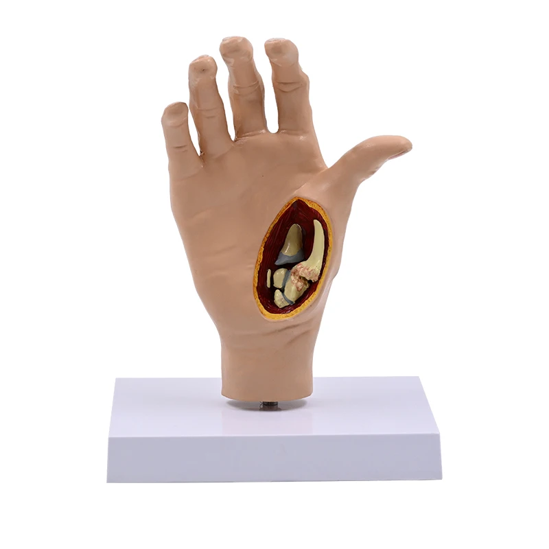 

1:1 Hand Bone Joint Model, Pathological Deformed Hand Bone Skeleton, Hand Tendon Ligament Muscle Anatomy Teaching Aids