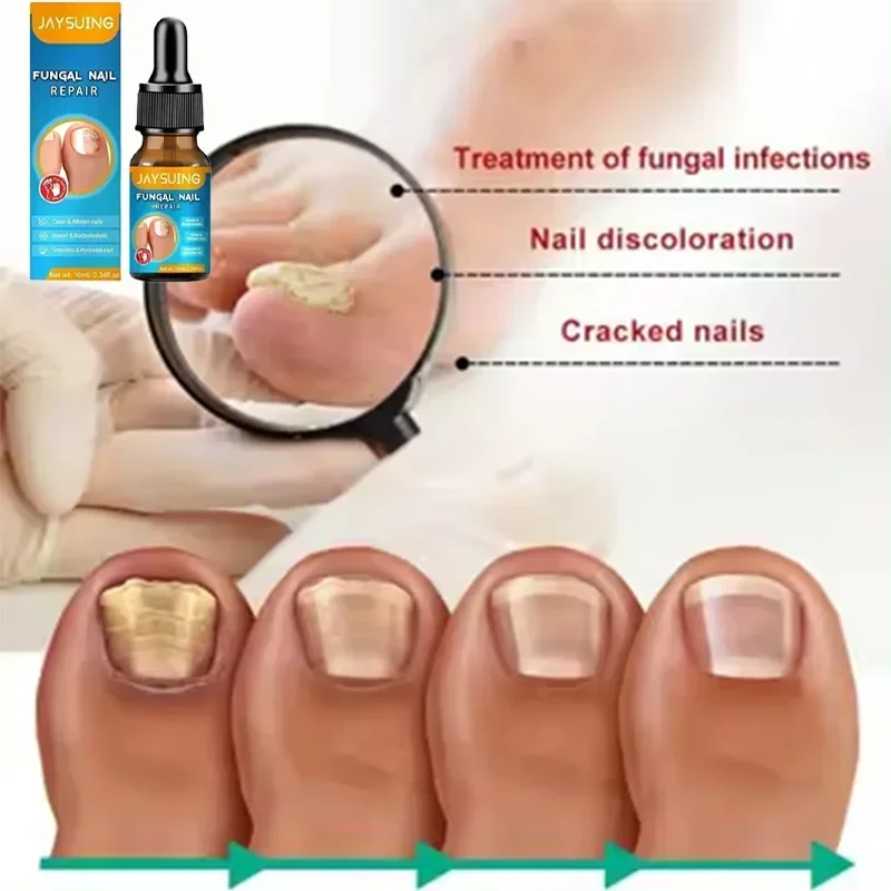 Nail Fungus Treatment Serum Toe Fungal Repair Products Hand Foot Care Removal Gel Anti Infection Paronychia Onychomycosis