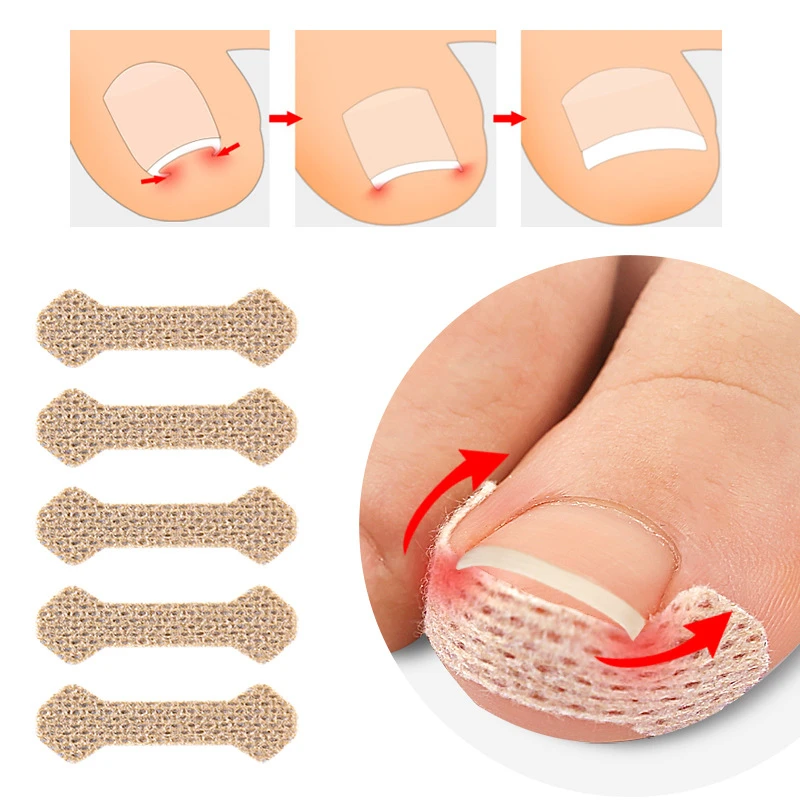 110Pcs=11Sheets Pedicure Ingrown Nail Tool Toenail Stickers Nail Corrector Paronychia Treatment Fixer Recover Bunion Feet Care