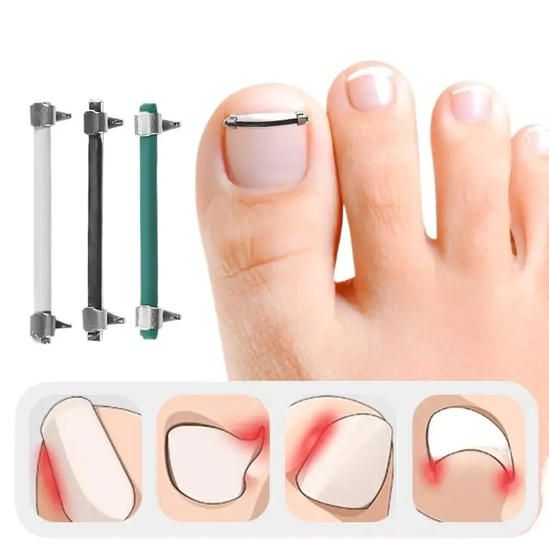 Ingrown Toenail Pedicure Tool Embed Toe Nail Care Straightening Correction Clip Curved Clamp Toenails Correction Tool For Toes