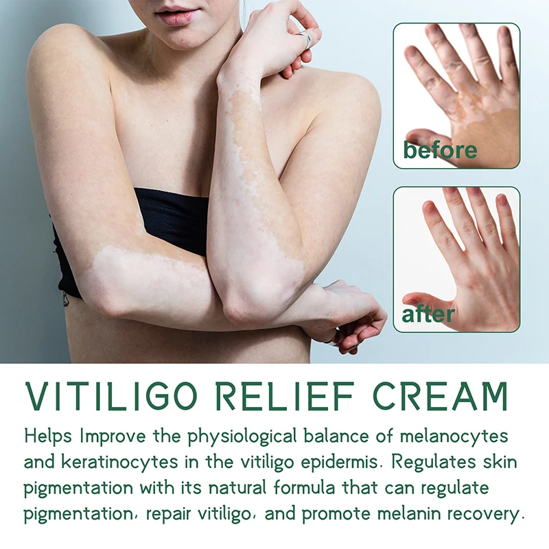 Vitiligo Pomada Remover Micose White Spot Gel Remoção Pele Vitiligo Eliminar Vitiligo Externo Skin Care Pomada 2023 Novo