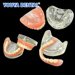 2 Implant Upper Lower Jaw Models  Dental Model Teeth Removable Bridge Implant Restoration Models Restoration Teaching Study