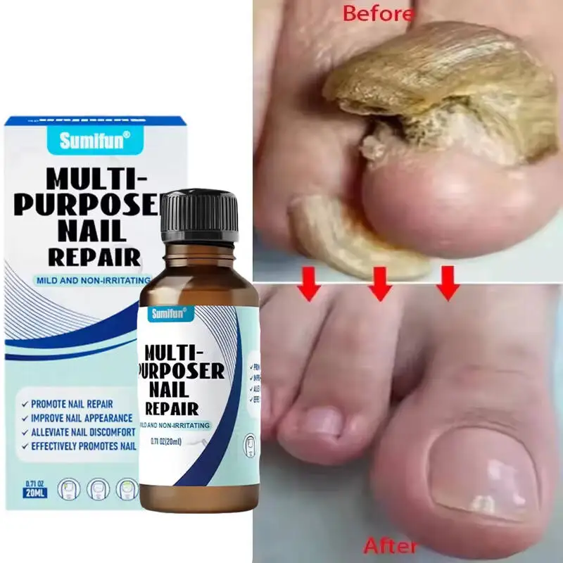 Tratamento de fungos nas unhas, soro para remoção de fungos nas unhas dos pés, gel de reparo, anti-infecção, paroníquia, onicomicose, essência para cuidados com as unhas dos pés