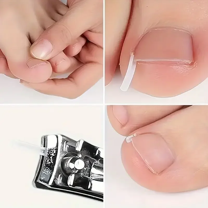 Ultradunne Ingegroeide Teennagel Corrector Gereedschap C-vormige Buis Pad Corrigeren Nagels Groei Paronychia Behandeling Herstellen Pedicure Gereedschap
