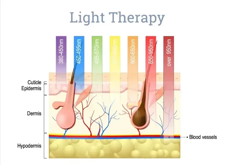 OPTAR IPL Wavelength Wave Plate Hair Removal Laser, profissional