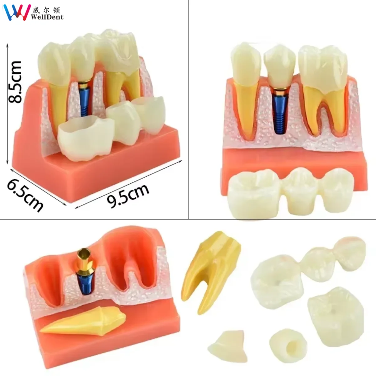 4 Times Implant Dental Teaching Model Implant Analysis Demonstration Removable Model Dentist Teaching Tools