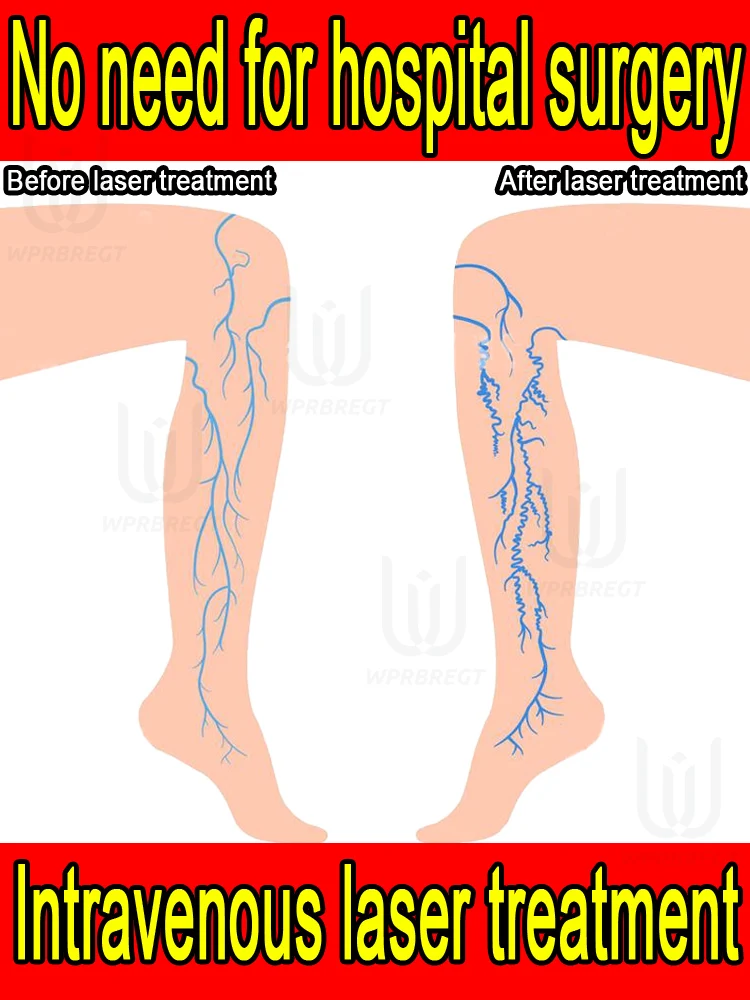 

2nd generation varicose vein laser eliminates vasculitis and phlebitis, relieves spider leg pain, laser pointer for treatment