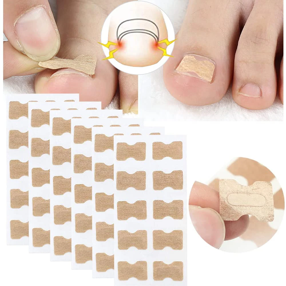 50/100pcs cerotti per il correttore dell'unghia incarnita adesivi per la cura della correzione delle unghie trattamento paronichia recuperare lo strumento per Pedicure correttore