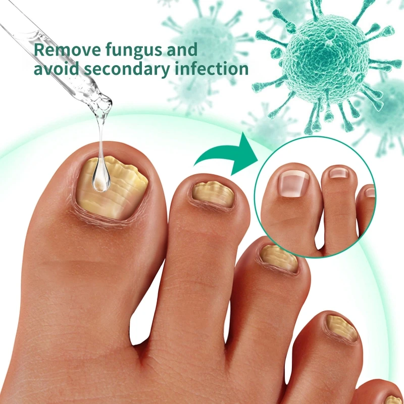 Toenail Drops Solution for Toenail Powerful Repair Liquid for Nails & Toenails