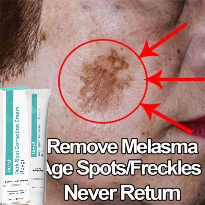 

Powerful Spot-removing Whiten Cream Brighten Skin Fast Eliminates Melanin Pigmentation Melasma Dark Spots Moisturize Beauty Gel