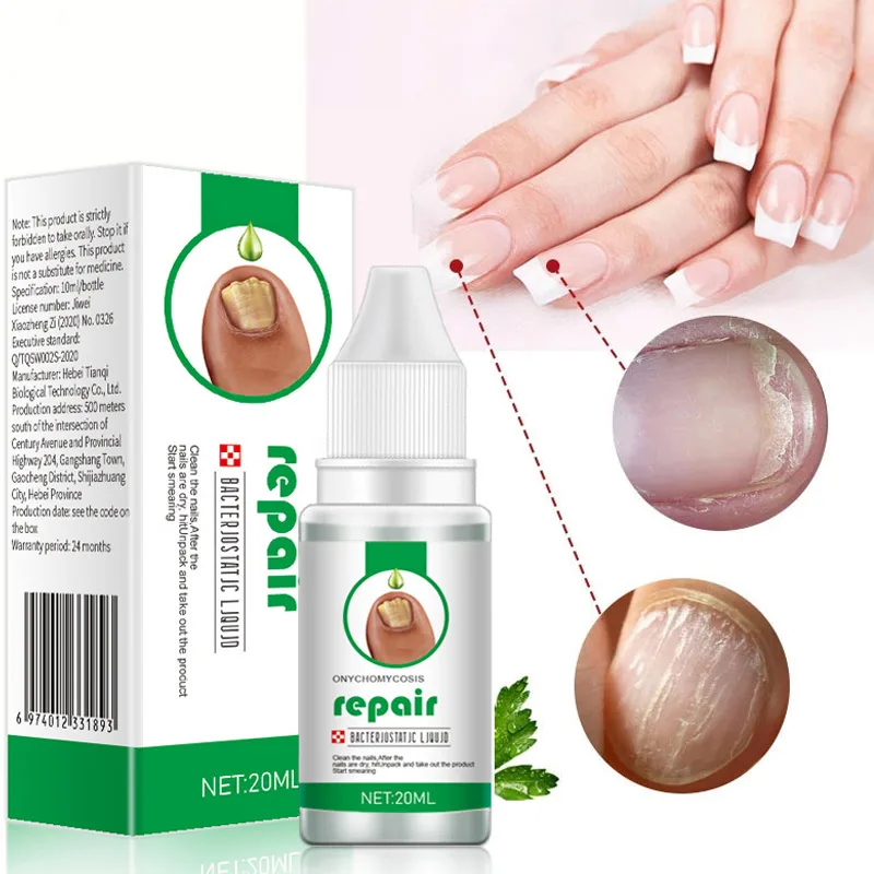 Unha fungo tratamento soro, Toe Fungal Repair Products, Mão Foot Care Remoção Gel, Anti infecção, Onicomicose Paroníquia, Novo