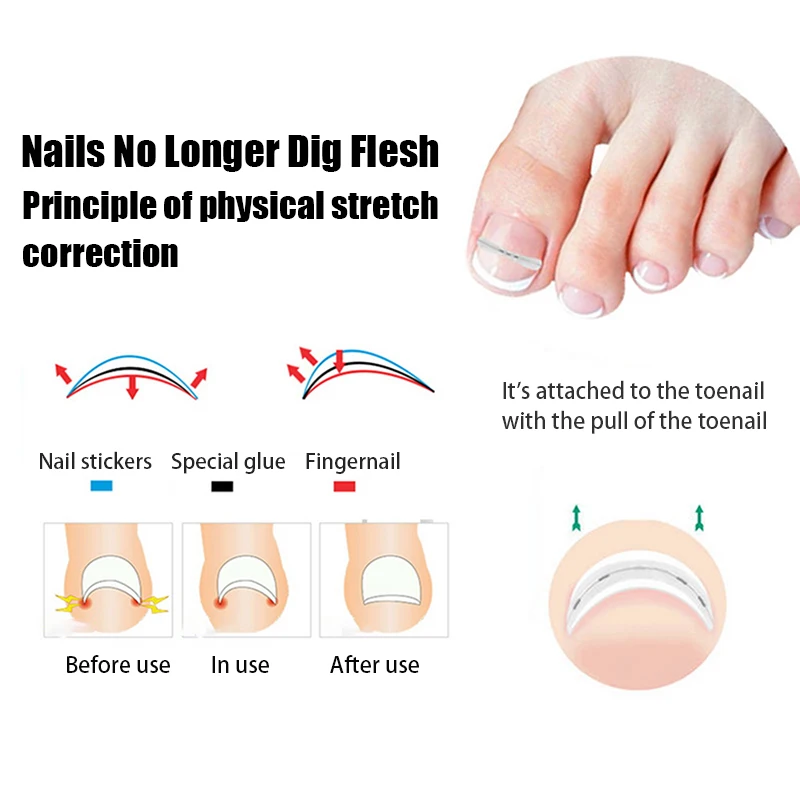 1set 13-19mm Nail Correction Stickers Ingrown Toenail Corrector Patches Paronychia Treatment Recover Care Pedicure Tools