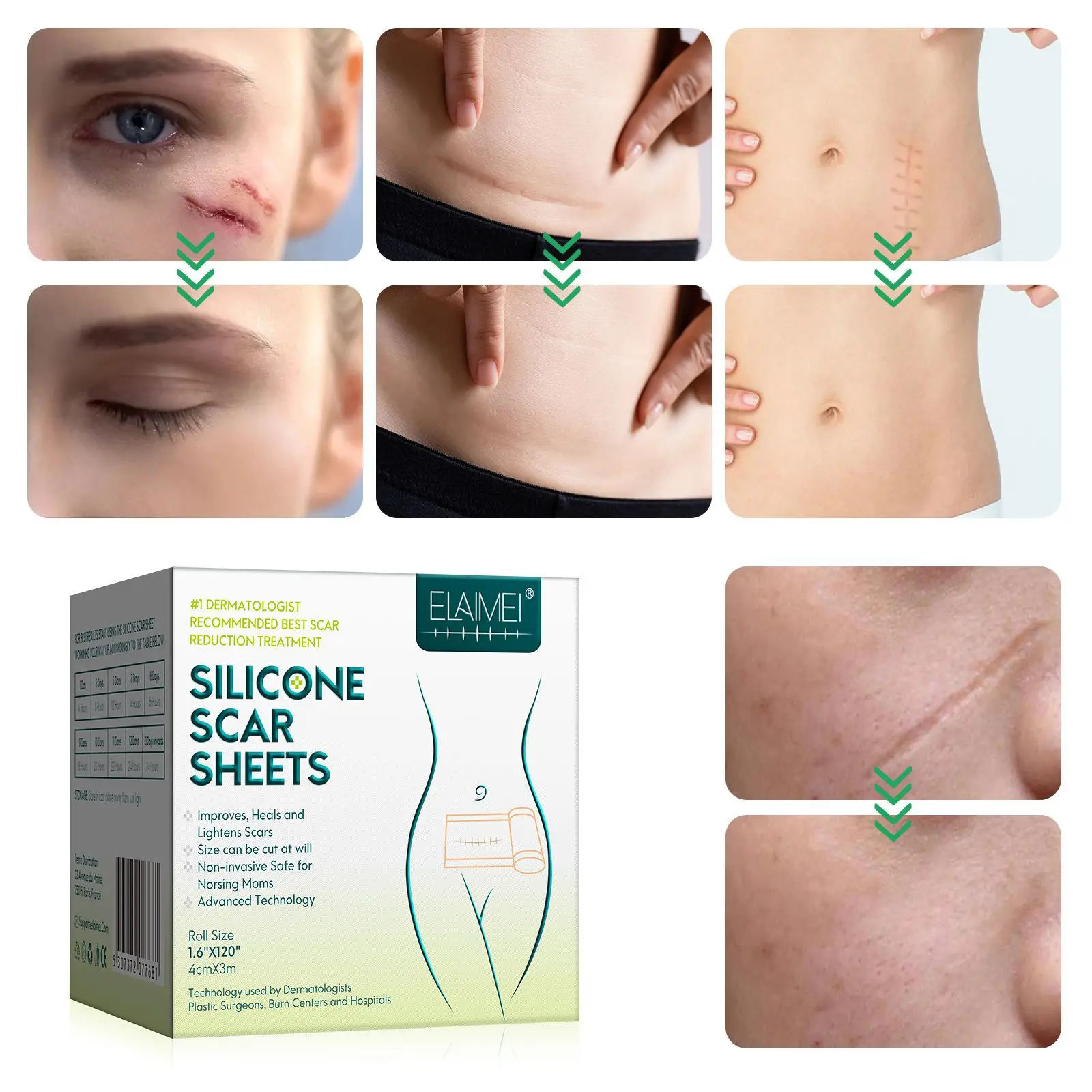 ELAIMEI Scar Patch Widened Self-adhesive Silicone Gel Scar Patch Invisible Patch C-section Scar Stretch Mark Repair 3 Meters