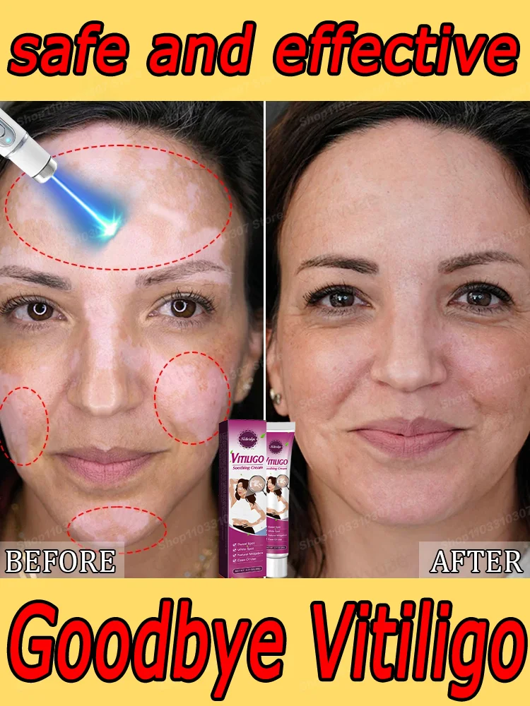 Vitiligo LaseR 𝖤𝗅𝗂𝗆𝗂𝗇𝖺𝗍𝖾 𝗏𝗂𝗍𝗂𝗅𝗂𝗀𝗈 𝗋𝖾𝗆𝗈𝗏𝖾 𝗌𝗉𝗈𝗍𝗌 𝗋𝖾𝗉𝖺𝗂𝗋 𝗐𝗁𝗂𝗍𝖾 𝗌𝗉𝗈𝗍𝗌