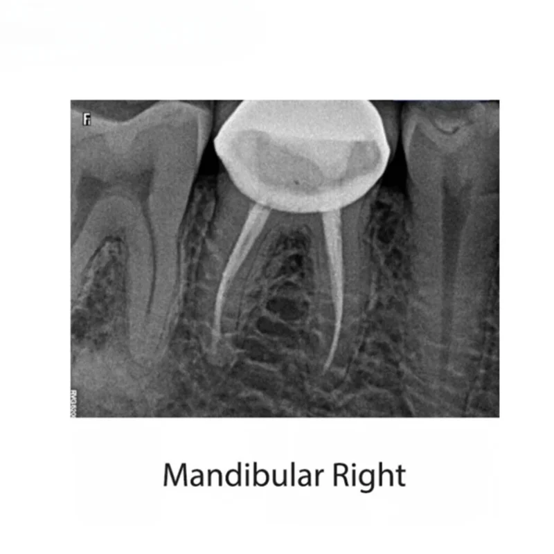 LK-C64 Carestream RVG5200 مستشعر الأشعة السينية الرقمي