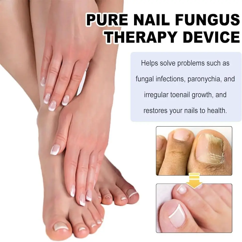 

Устройство для лечения ногтей на ногах, устройство для фотосъемки чистых ногтей, высокоеэффективное устройство для лечения грибка ногтей, портативное, перезаряжаемое