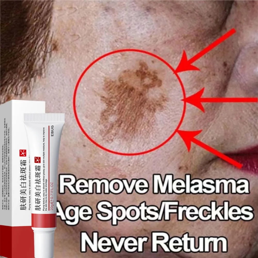 Effective Whiten Freckle Cream Remove Dark Spot Melasma Fade Melanin Anti-Pigmentation Improve Dullness Brighten Face Skin Care